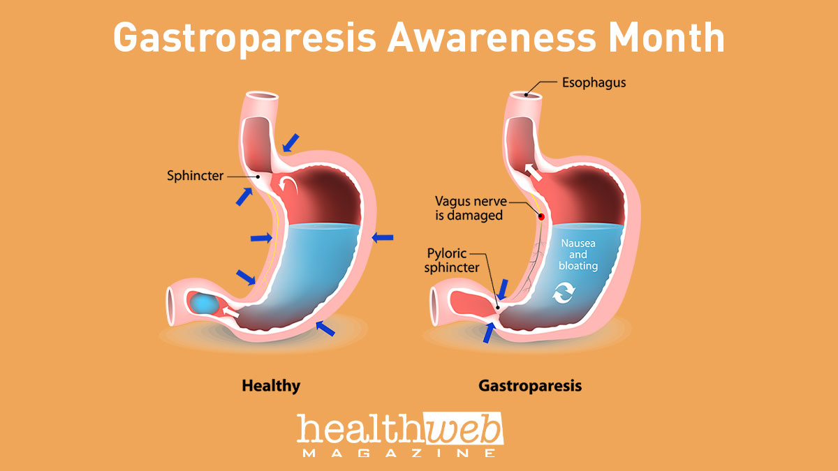 August is #GastroparesisAwarenessMonth, dedicated to improving the understanding & management of this motility disease. #GastrointestinalDisorders #Diabeticgastroparesis #vitamins #minerals #healthydigestivesystem #gastroparesisdiagnosis #gastroparesispatients #healthwebmagazine