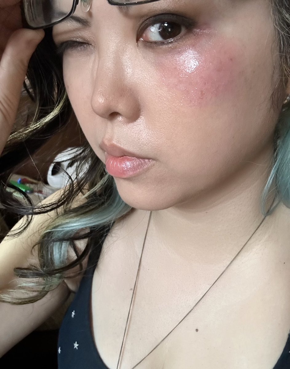 Yep. I’ve given myself a black eye. 🤦‍♀️