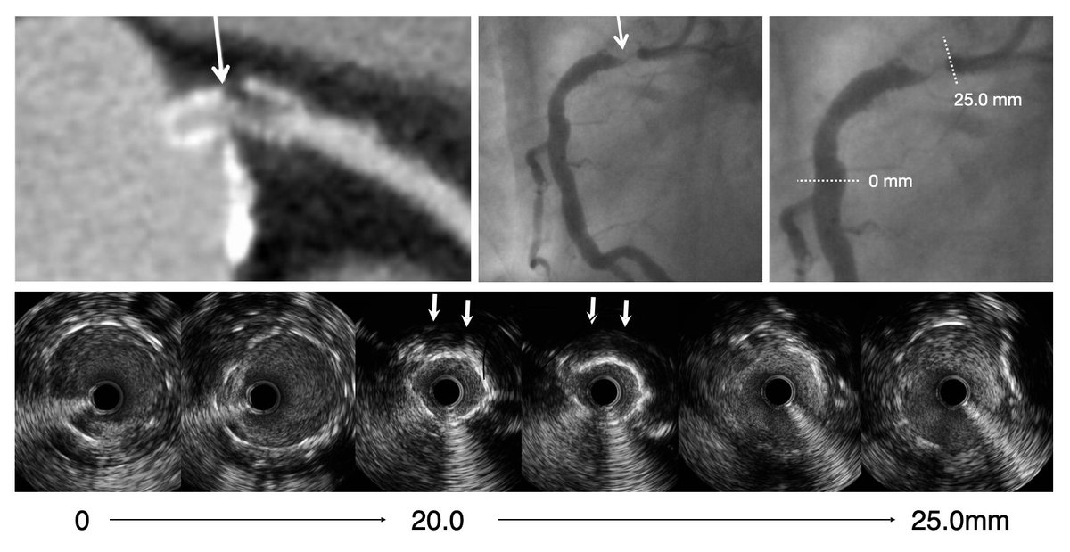 This patient presented with restenosis at follow‐up after stent implantation in the right coronary artery (arrows on angiogram and telling angiotomography images, top panel). On IVUS, all stent struts are seen at proximal and distal references (e.g. 20 mm and 25 mm), whereas at