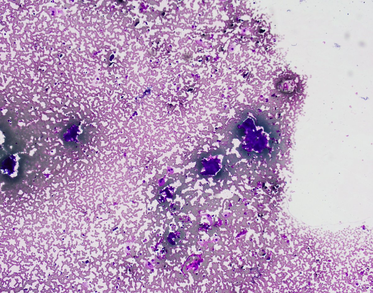 UAB Pathology (@uabpathology) on Twitter photo #UABCyto case by Dr. Mike Robinson: 55 y/o M. Right thyroid nodule (1.8cm) FNA: colloid and groups of round to polygonal cells w/ granular cytoplasm and round centrally/eccentrically placed nuclei. This is a follicular neoplasm, oncocytic type (formerly a Hurthle cell neoplasm). #UABCyto case by Dr. Mike Robinson: 55 y/o M. Right thyroid nodule (1.8cm) FNA: colloid and groups of round to polygonal cells w/ granular cytoplasm and round centrally/eccentrically placed nuclei. This is a follicular neoplasm, oncocytic type (formerly a Hurthle cell neoplasm).