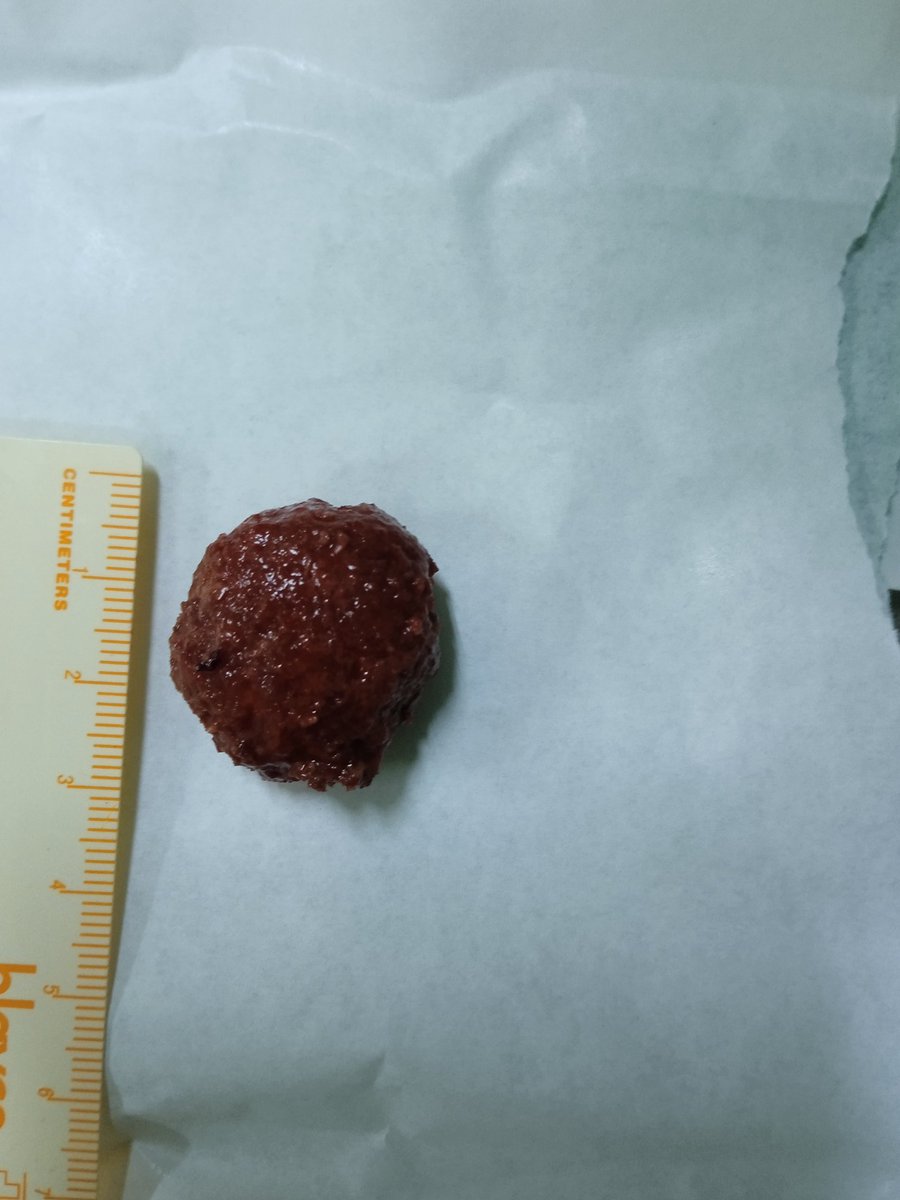 drbabakri's tweet photo. #Lap #pyelolithotomy for renal pelvic stone https://t.co/LhkhS4Mkqv