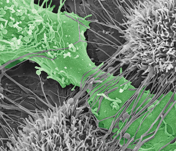 NotreDame's tweet photo. Notre Dame researchers have shed new light on why obesity makes ovarian cancer more deadly.

 A high BMI is linked to alterations in the structure and environment of cancerous tumors: https://t.co/44jUkd1S3p https://t.co/7z6CA6azQF