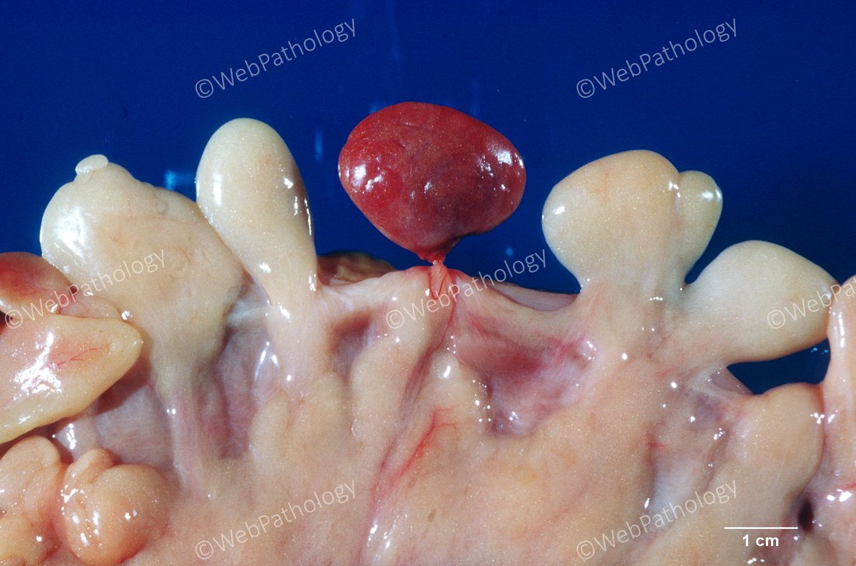 WebPathology's tweet photo. Incidental finding. Diagnosis? https://t.co/rnMWRr25iC