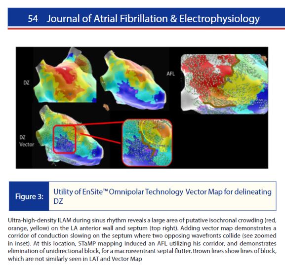 Isochronal Late Activation Mapping for Atrial Flutter buff.ly/3rHQI28  @abbottcardio @sutterhealth