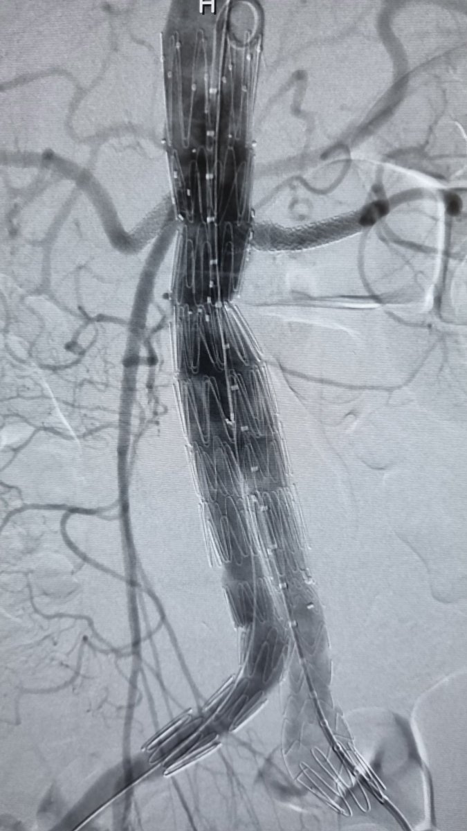 Percutaneous fenestrated EVAR for a 6.5cm AAA with L renal ostium saccular aneurysm. #aortaed #vascularsurgery #irad #surgery #vascular
