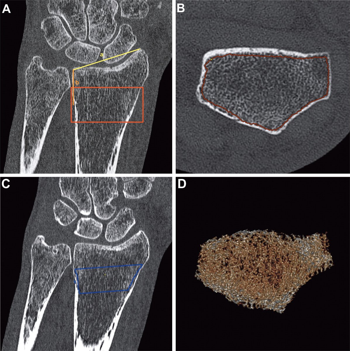 Opportunistic DECT volumetric bone mineral density assessment can be used to predict the requirement for bone substitutes during surgical management and nonunion in patients with distal radius fractures. bit.ly/3OlCls2