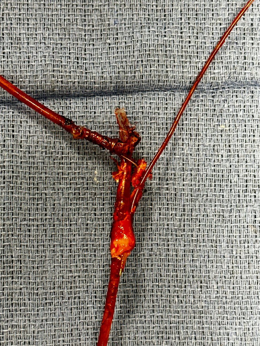 AlbertLinMD1's tweet photo. What lead to lead binding looks like. Congenital pt with 5 leads and fractured >10 y/o RV ICD lead, non-functional LV lead. Snowplowed the ICD which was snared femorally. That is the LV lead bound to RV lead. https://t.co/1wxOZ0an33
