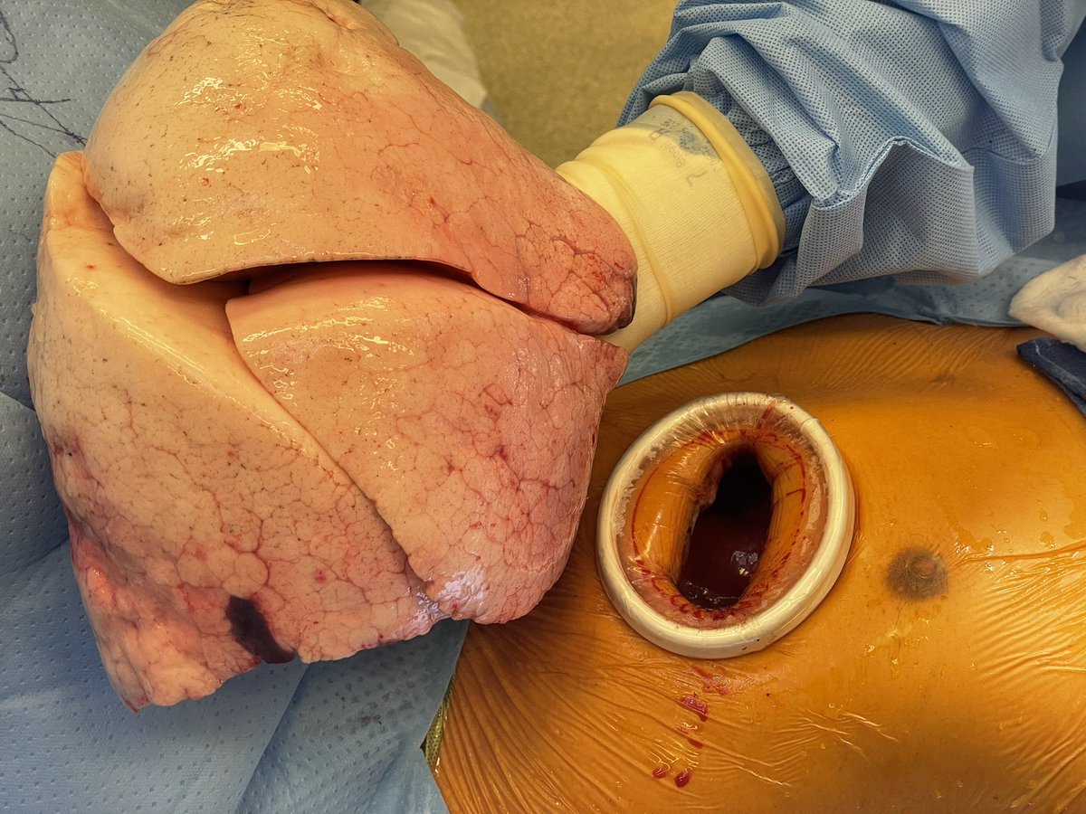 Yes, it will fit! The benefit of a minimally invasive approach to #lungtransplant. 4L lung volume through a 6cm incision #transplant #surgery <a href="/CedarsSinai/">Cedars-Sinai</a>