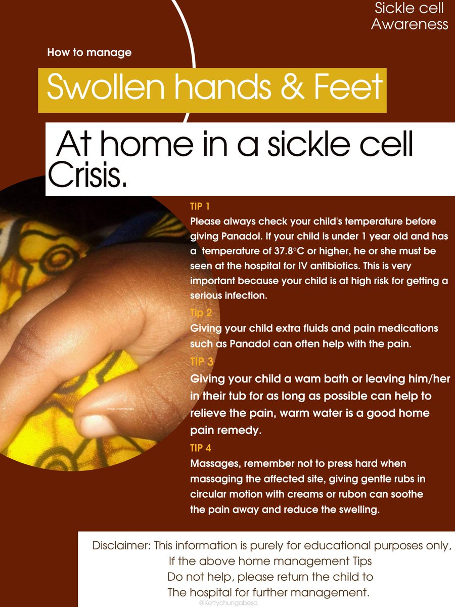 kettychunga's tweet photo. Working to raise more sickle cell awareness!
Developed the poster on the  Home Management of #Dactilytis in babies with #SickleCellDisease with the help of the Pediatrician, Doctor Chirwa.
Work in progress are the translations into the zambian local languages.
#SCDAwareness https://t.co/d9vx5nRyXA