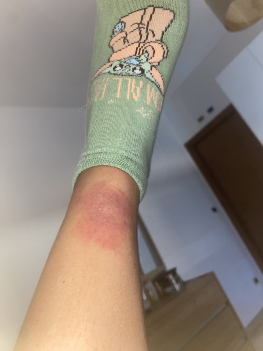 era un semplice morso di zanzara