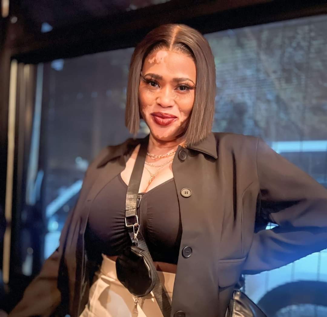 TheRealStekana's tweet image. Look Arts You 😍😍😍🤌

#Vitiligo 
#YouAreNotYourSkin
#GodsArt