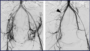 iRadPulse (@iradpulse) on Twitter photo 1/6 🚨 New Study Exploring Cesarean Hysterectomy! 🚨
<a href="/JVIRmedia/">JVIR</a> published a new study comparing prophylactic multivessel vessel embolization (MVE) to internal iliac artery occlusion balloon (IIABO) placement for placenta accreta spectrum (PAS).
#PlacentaAccreta #iRads 1/6 🚨 New Study Exploring Cesarean Hysterectomy! 🚨
<a href="/JVIRmedia/">JVIR</a> published a new study comparing prophylactic multivessel vessel embolization (MVE) to internal iliac artery occlusion balloon (IIABO) placement for placenta accreta spectrum (PAS).
#PlacentaAccreta #iRads