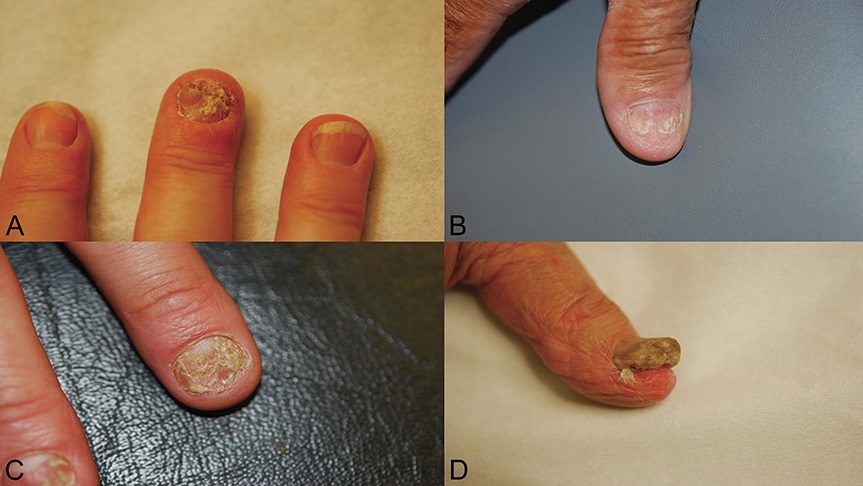 AJDP_Journal's tweet photo. #psoriasisawarenessmonth

CD8+ T cells play a crucial role in the pathogenesis of nail psoriasis, in a pathogenic pathway similar to that of Psoriatic arthritis.

Full article: https://t.co/MKHjyDf2qn

#psoriasis #nailpsoriasis #pathontwitter #dermpath #pathology #dermatology https://t.co/CC6ZTrlzYJ