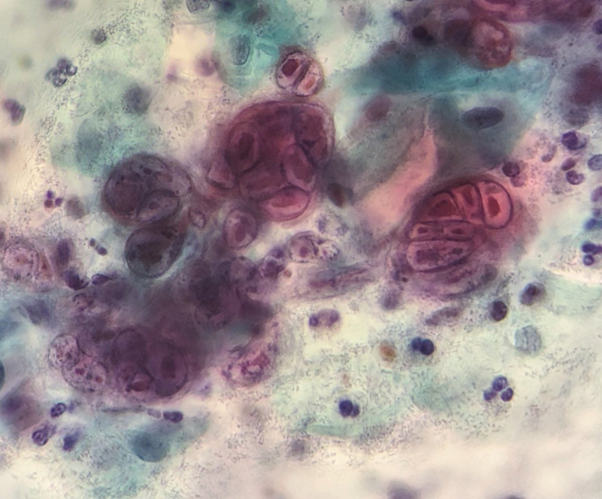 PSzwebel's tweet photo. Conventional Pap Smear.
Herpes Virus https://t.co/iyrZqJf3RK