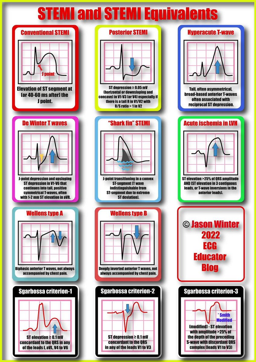 ResusMed's tweet photo. STEMI and STEMI Equivalents https://t.co/kK3roViqzO