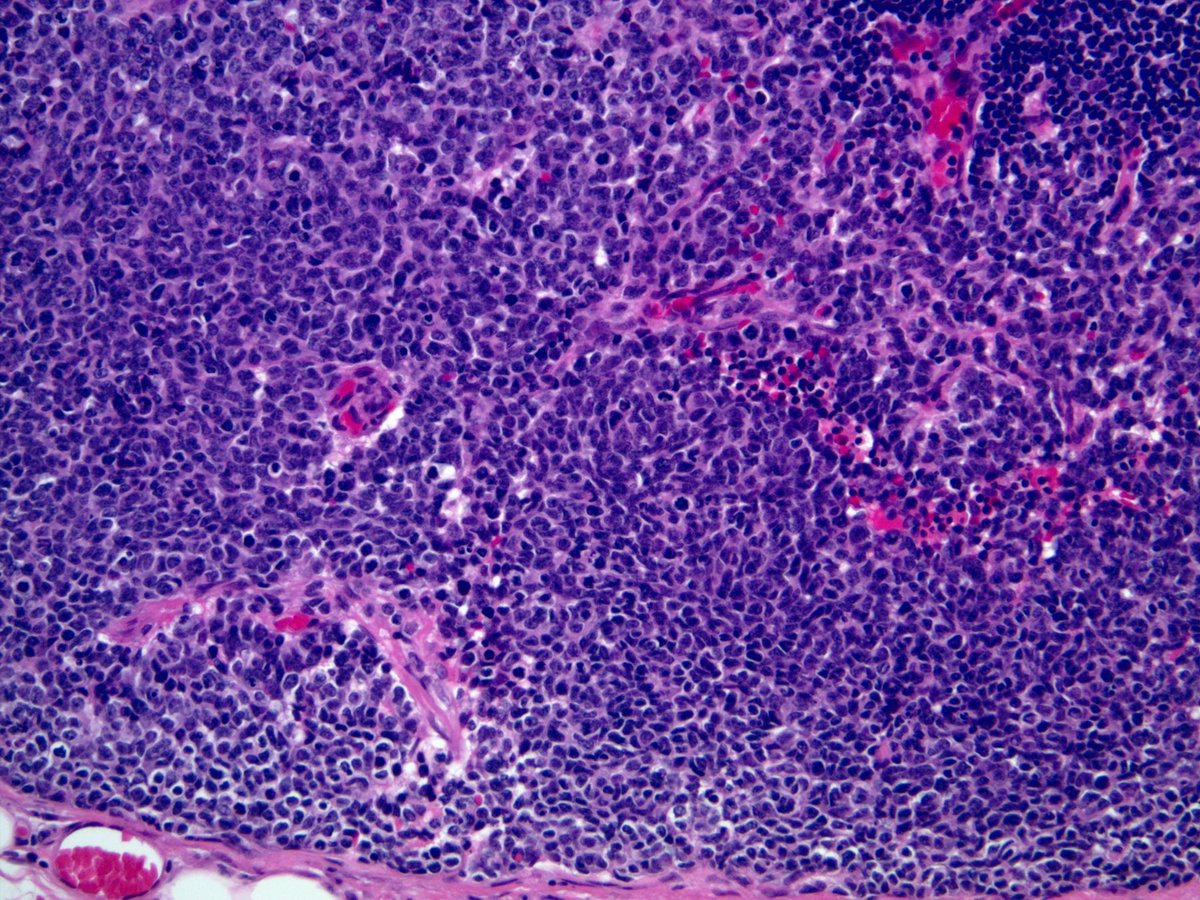 smlungpathguy's tweet photo. O Brave and Wise Tweeples, this lymph node met was positive for cytokeratin and synaptophysin. Is it small cell carcinoma or large cell neuroendocrine carcinoma?
For size comparison, I have included "resting lymphocytes". #pathology #pulmpath @ariella8 @Janiranavarro https://t.co/87MDsRHz08
