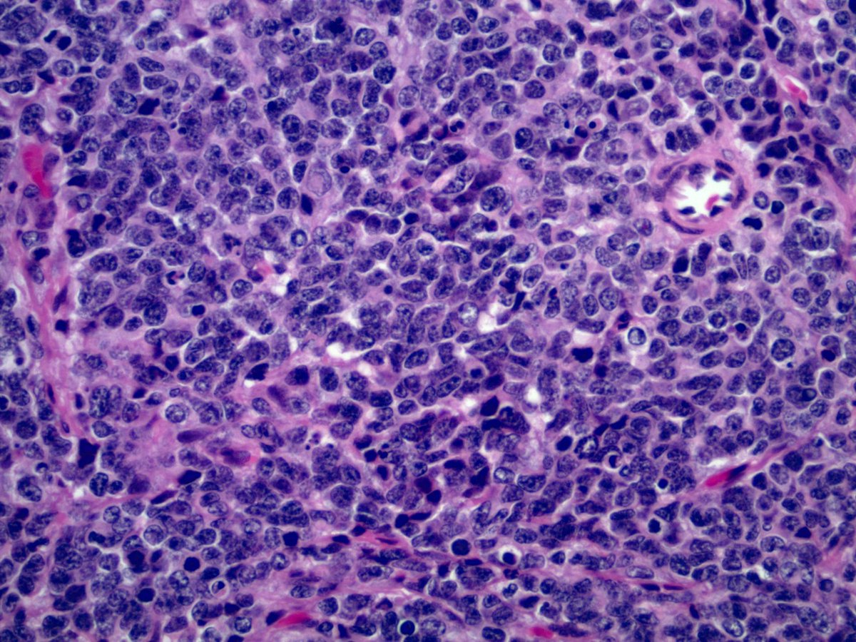 smlungpathguy's tweet photo. O Brave and Wise Tweeples, this lymph node met was positive for cytokeratin and synaptophysin. Is it small cell carcinoma or large cell neuroendocrine carcinoma?
For size comparison, I have included "resting lymphocytes". #pathology #pulmpath @ariella8 @Janiranavarro https://t.co/87MDsRHz08