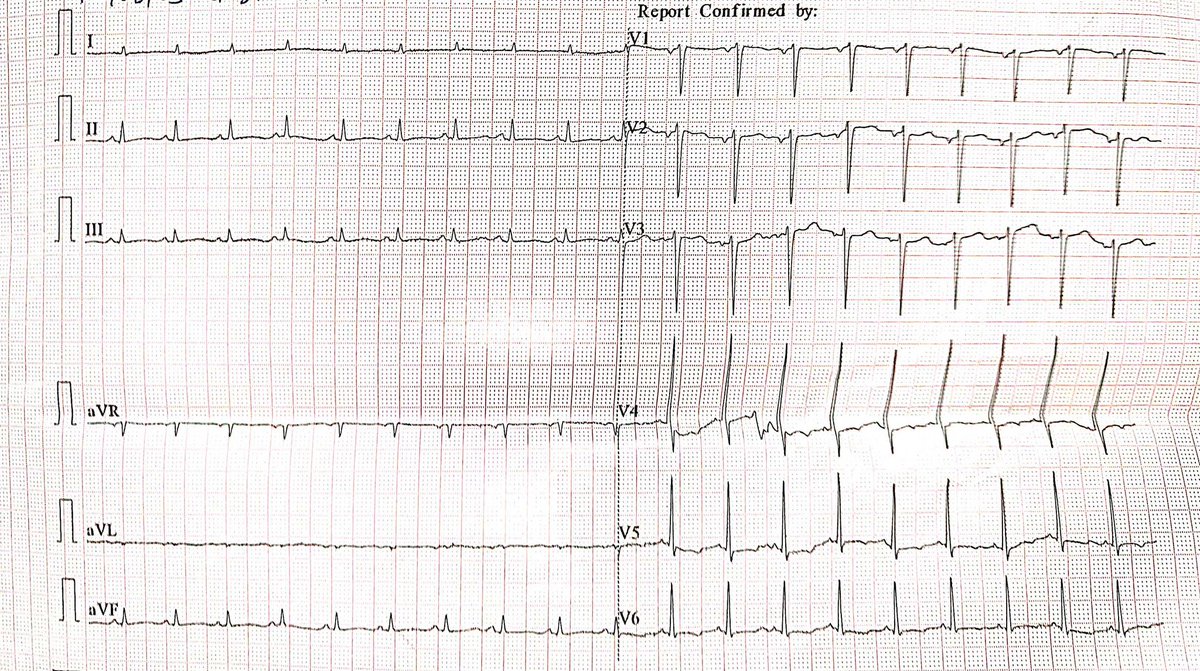 Harshdeep84's tweet photo. Here’s a critical #ECG pattern from a 64-year-old CKD 5 patient with shortness of breath 
What's the diagnosis? https://t.co/x9afKciKzU