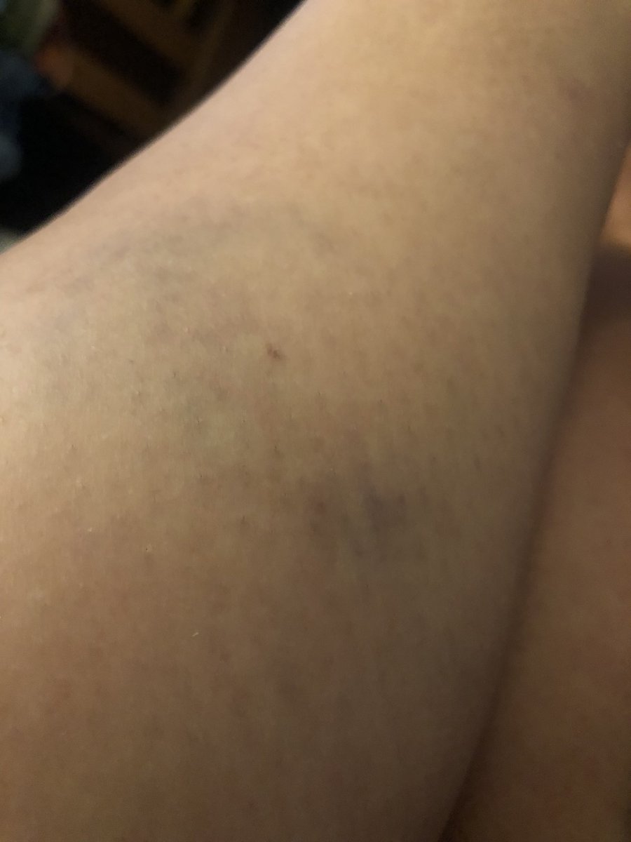 yolipurple's tweet photo. @RedbridgeLive Shoved, Kicked and Bruised, continually targeted and harassed by this Parking Enforcement Officer how is he still employed by Redbridge and I am still at fault!!! @MPSRedbridge Is my case going to be taken seriously?! #MentalHealthMatters https://t.co/XJKKFgQkP6
