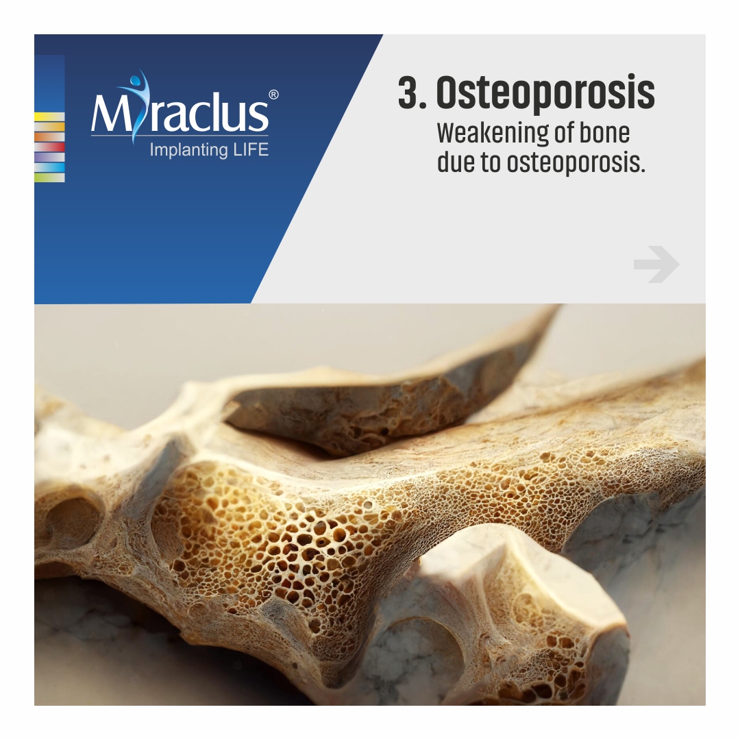 MiraclusOrtho's tweet image. Below are the 4 common causes of tibia fractures.

miraclus.com/trauma/proxima…

#proximaltibia #tibia #innovation #miraclus #ortho #orthoimplants #orthopaedicsurgeon #surgeon #india #medical #trauma #surgery #shin #femur #medicalimplant #bone #uppertibia