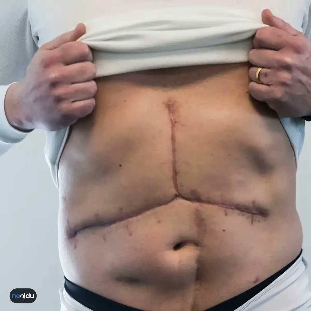 Organ nakli tweetim baya etkileşim aldı. Böyle söyleyince kolay gibi sanılıyor galiba. Organ naklinde hem 4. Sınıf Genel Cerrahi stajında, hem de intörnlükte çalıştım. İntörnlükte 1 günümü anlatayım.

Sabah 5.30'da kalkıyordum. 6.00 'da hastanede olmam gerekiyordu. Serviste