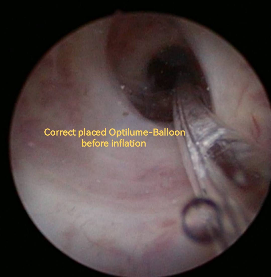 OTosev's tweet photo. Unexpected second bulbar stricture was  discovered during #Optilume treatment. But https://t.co/Kp4p9GaadA.univ. Georgi #Tosev and his professional team are always ready to deal with any unexpected turns during the operation! https://t.co/2ojX7CbyyI
