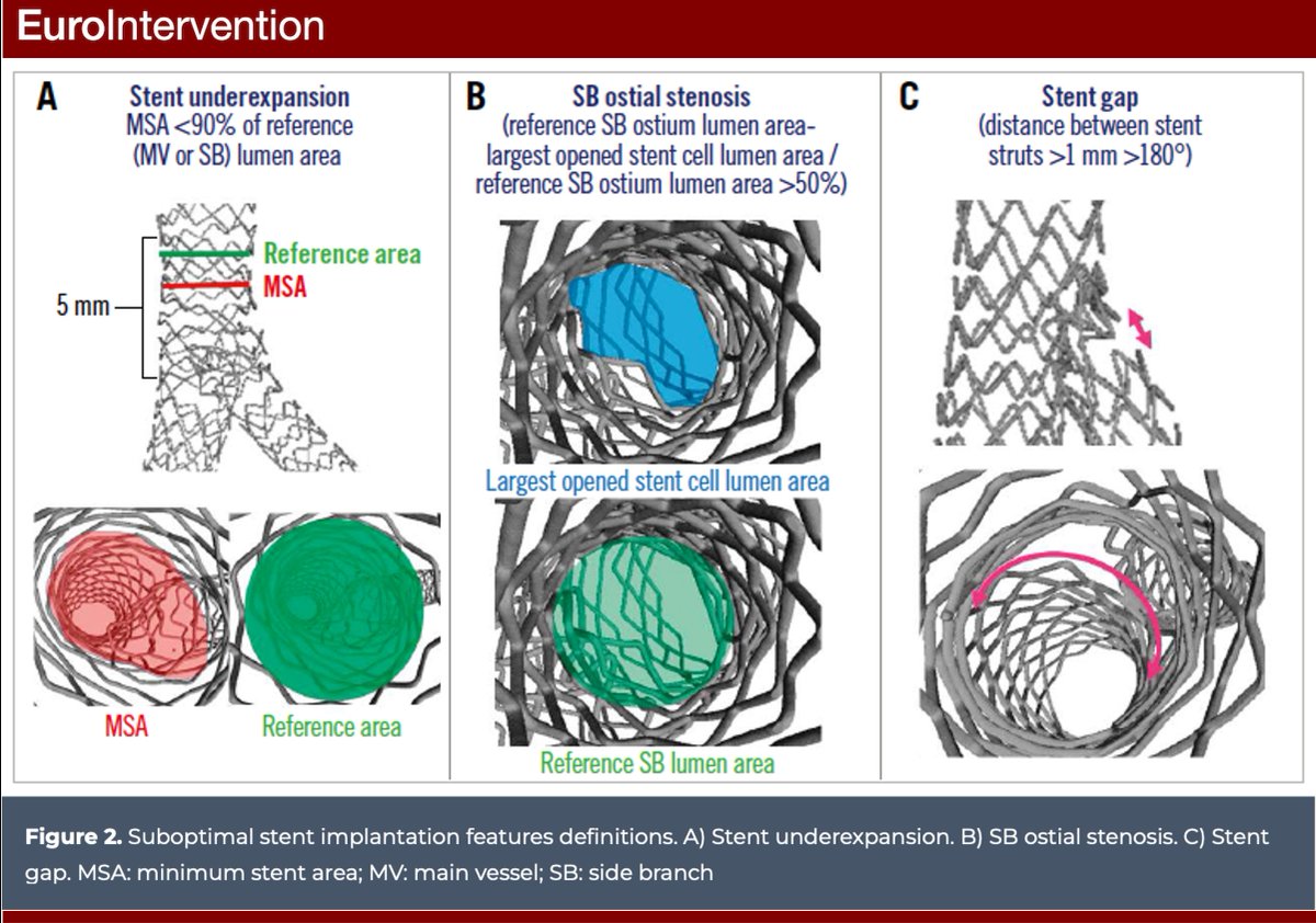 The MOBBEM study evaluated the stent configuration achieved after PCI with 2-stent techniques in explanted beating hearts via micro-CT. Despite a favourable experimental environment, suboptimal stent implantation was observed in as many as 53.7% of cases. ow.ly/1yQ450PxZFW