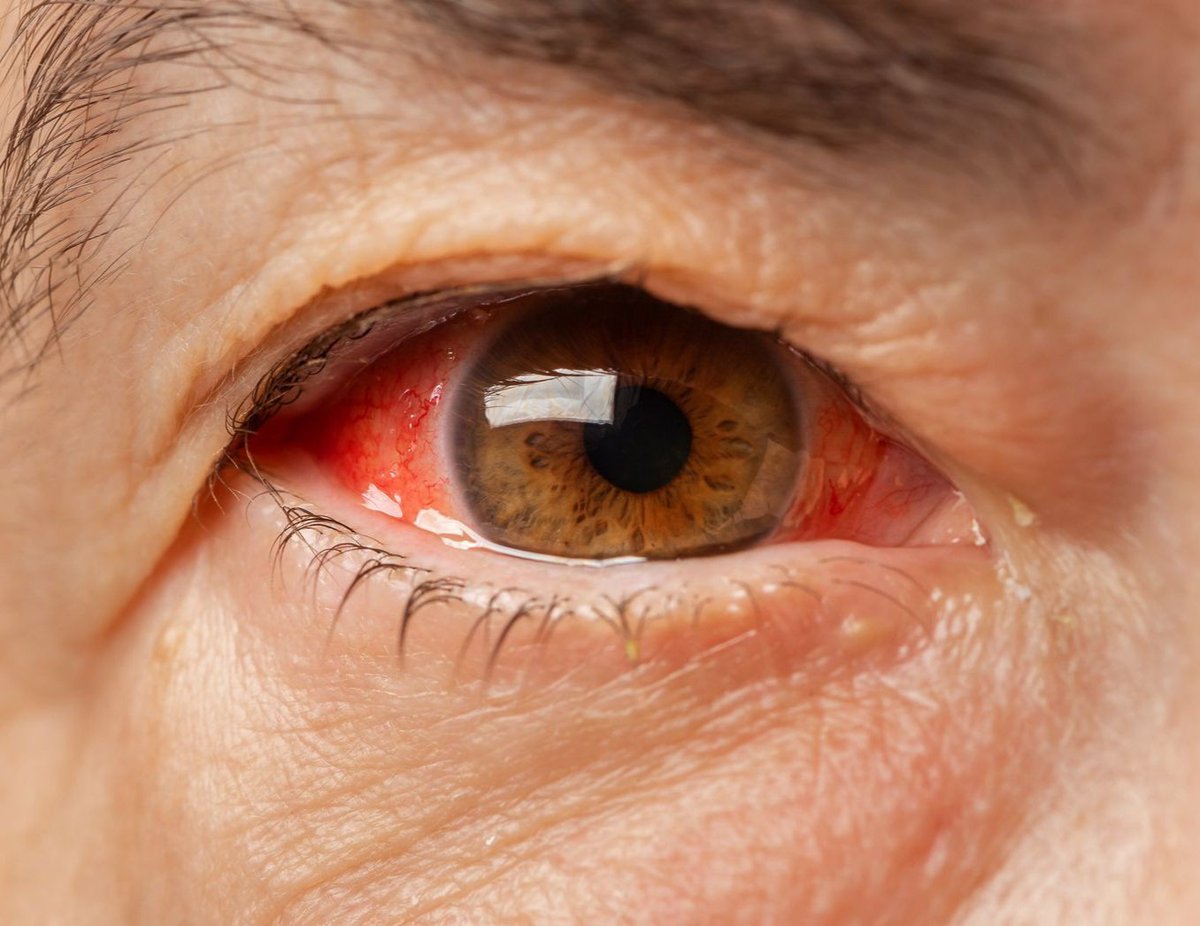 docSubaash's tweet image. There&apos;s a rise in conjunctivitis cases across the country &amp;amp; shortage of antibiotics for bacterial conjunctivitis. A temporary way to mitigate this problem could be to advise the patients to get the medicines from the health care centres at periphery, most of which have the stock.