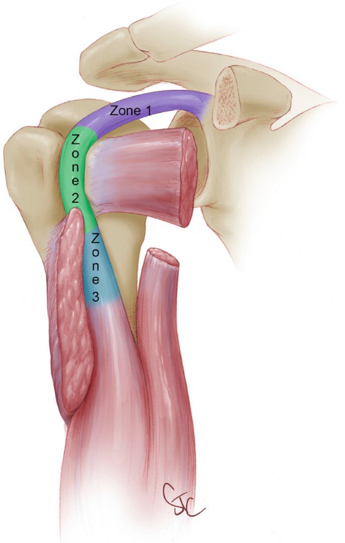 Bonita imagen del tendón de la cabeza larga del bíceps.

link.springer.com/chapter/10.100…