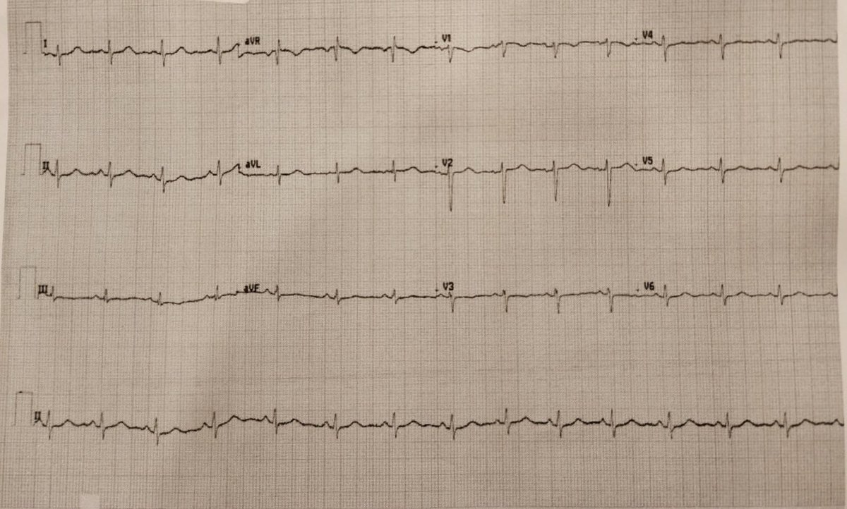 la786786's tweet photo. 46 y/o female coming with long term "gastritis". what can you tell about this ECG? https://t.co/auG6rKjNXV