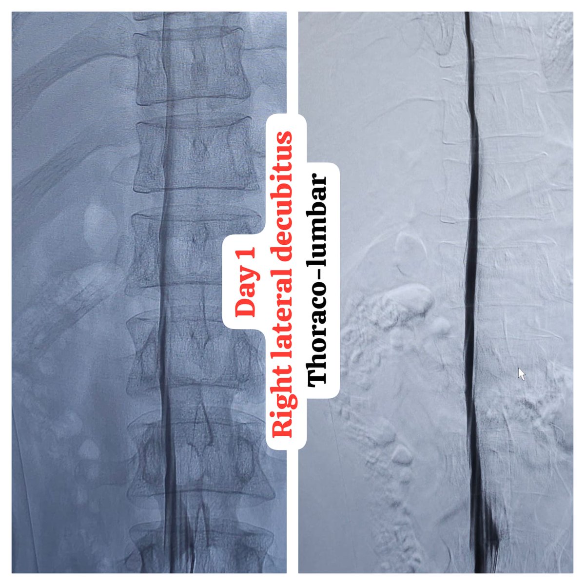 SharathKumarGG7's tweet image. One of the very few centers in the country to offer Digital subtraction Myelography (DSM) @ApolloKarnataka for the Spinal CSF leak patients by our team @SavithKumarINR good news to our patients in India @SpinalCSFCanada @spinalCSFleak @CsfLeakIreland @csfleakinfo #SpinalCsfLeak