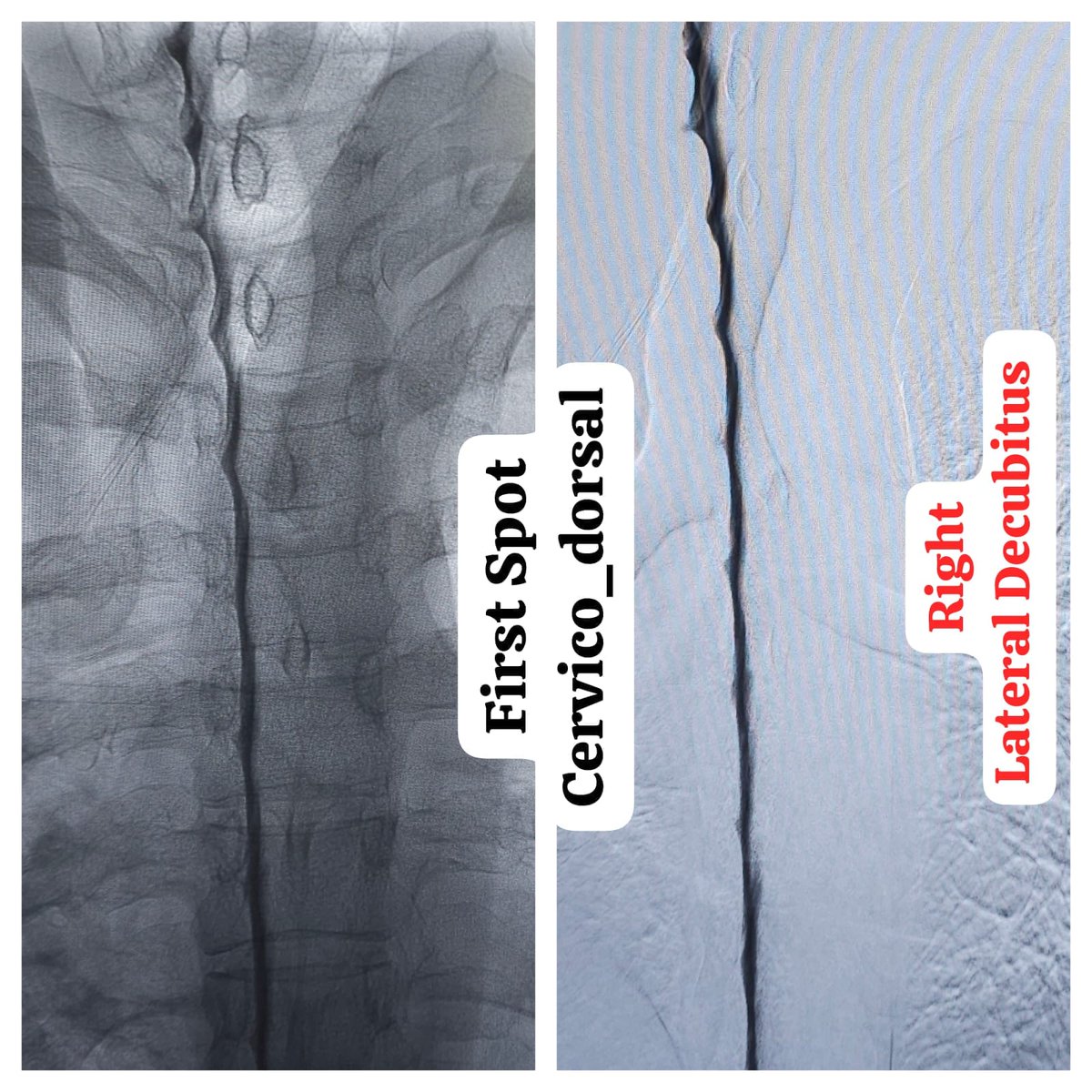 SharathKumarGG7's tweet image. One of the very few centers in the country to offer Digital subtraction Myelography (DSM) @ApolloKarnataka for the Spinal CSF leak patients by our team @SavithKumarINR good news to our patients in India @SpinalCSFCanada @spinalCSFleak @CsfLeakIreland @csfleakinfo #SpinalCsfLeak