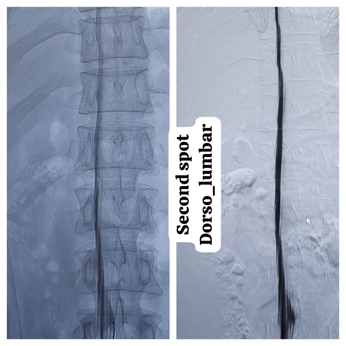 SharathKumarGG7's tweet image. One of the very few centers in the country to offer Digital subtraction Myelography (DSM) @ApolloKarnataka for the Spinal CSF leak patients by our team @SavithKumarINR good news to our patients in India @SpinalCSFCanada @spinalCSFleak @CsfLeakIreland @csfleakinfo #SpinalCsfLeak