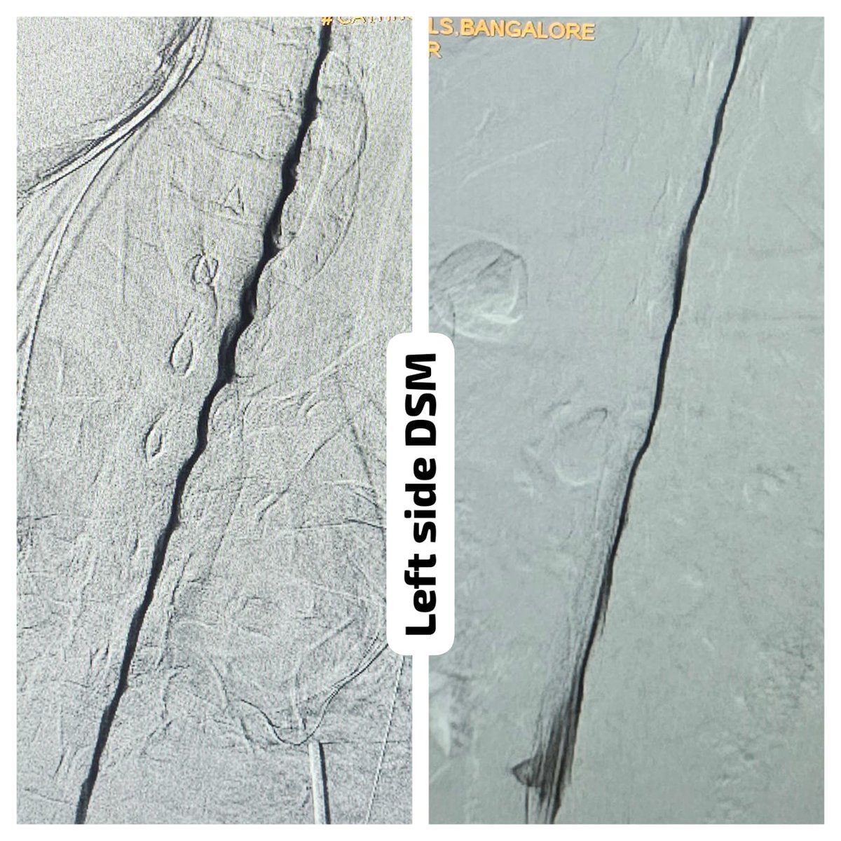 SharathKumarGG7's tweet image. One of the very few centers in the country to offer Digital subtraction Myelography (DSM) @ApolloKarnataka for the Spinal CSF leak patients by our team @SavithKumarINR good news to our patients in India @SpinalCSFCanada @spinalCSFleak @CsfLeakIreland @csfleakinfo #SpinalCsfLeak