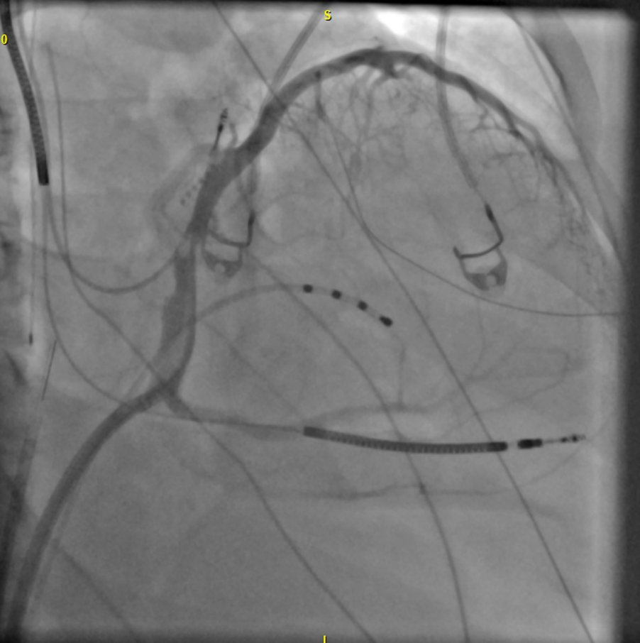 Step 1: CS venogram and selection of the target vessel