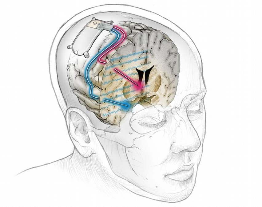 Bio_comunidad's tweet photo. _
El primer implante cerebral para tratar la depresión severa.

Los científicos han tratado con éxito a un paciente con depresión severa utilizando un implante cerebral.

Los investigadores descubrieron un biomarcador neural que indica el inicio de los síntomas de depresión y lograron crear un dispositivo personalizado para suprimir los síntomas.

El dispositivo es similar a un marcapasos y acceder a un circuito específico del cerebro que está relacionado con la depresión.

El dispositivo realiza una estimulación cerebral profunda y solo se activa cuando reconoce patrones depresivos.

Este enfoque personalizado alivió los síntomas de depresión de la paciente de manera inmediata y ha durado más de 15 meses desde que se implantó el dispositivo.

El estudio representa un éxito importante en el tratamiento de trastornos psiquiátricos gracias a la neurociencia.

DOI: 10.1038/s41591-021-01480-w

No olvides seguirnos  ❤️