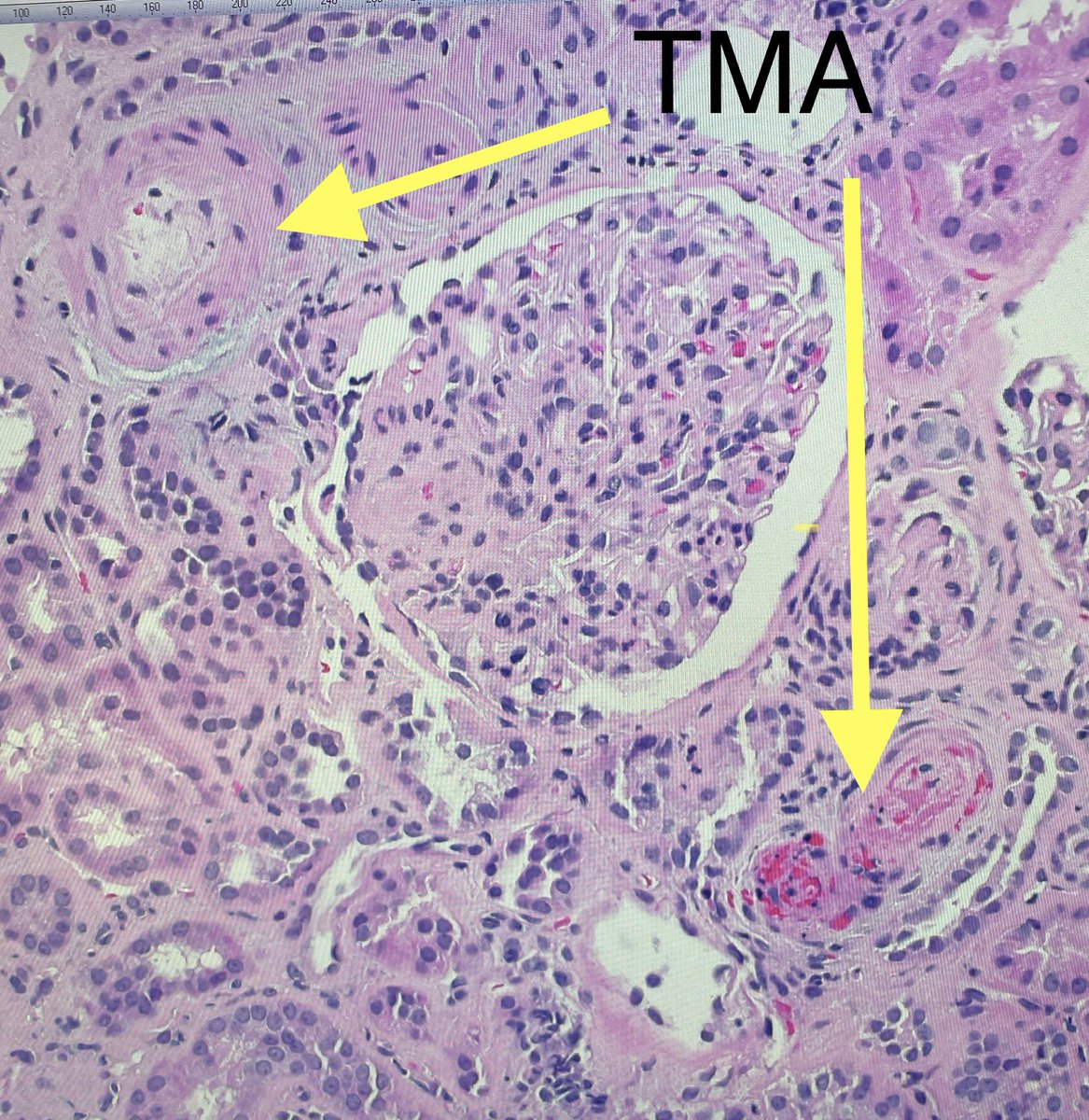 SethiRenalPath tweet picture