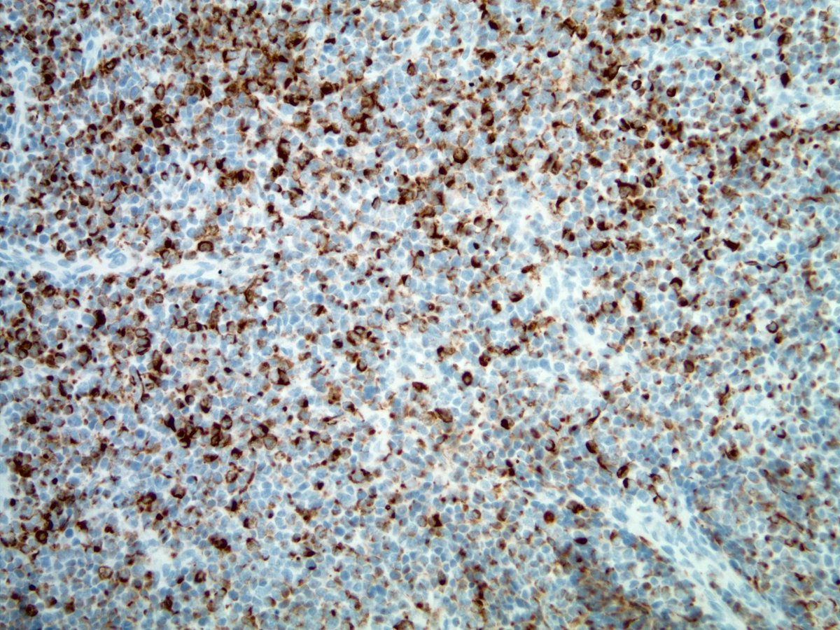 smlungpathguy's tweet photo. This is desmoplastic small round cell tumor. Nuclear #ihcpath is WT1 (pos) , cytoplasmic is desmin (pos). Fusion was pos. Of course, this is impossible to diagnose on H&E alone. Just a rare tumor to consider in a young patient with a small round blue cell tumor. https://t.co/OZK8uTva1e