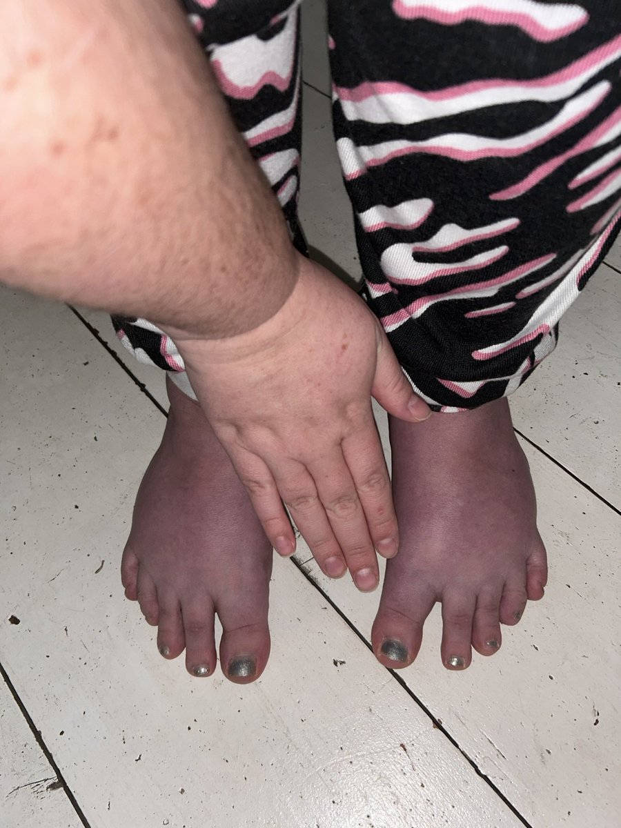 Lizzy H (@hopefullizzy) on Twitter photo Dr Manoj Sivan <a href="/UniversityLeeds/">University of Leeds</a>
I have this too, many of us with M.E after viruses have this, but no one has been interested๐ฅบ many of us have POTS also.
Post viral illnesses absolutely devastate lives.
(Hand in photo for colour comparison) apple.news/A7kJkcnEPR8qqHโฆ Dr Manoj Sivan <a href="/UniversityLeeds/">University of Leeds</a>
I have this too, many of us with M.E after viruses have this, but no one has been interested๐ฅบ many of us have POTS also.
Post viral illnesses absolutely devastate lives.
(Hand in photo for colour comparison) apple.news/A7kJkcnEPR8qqHโฆ