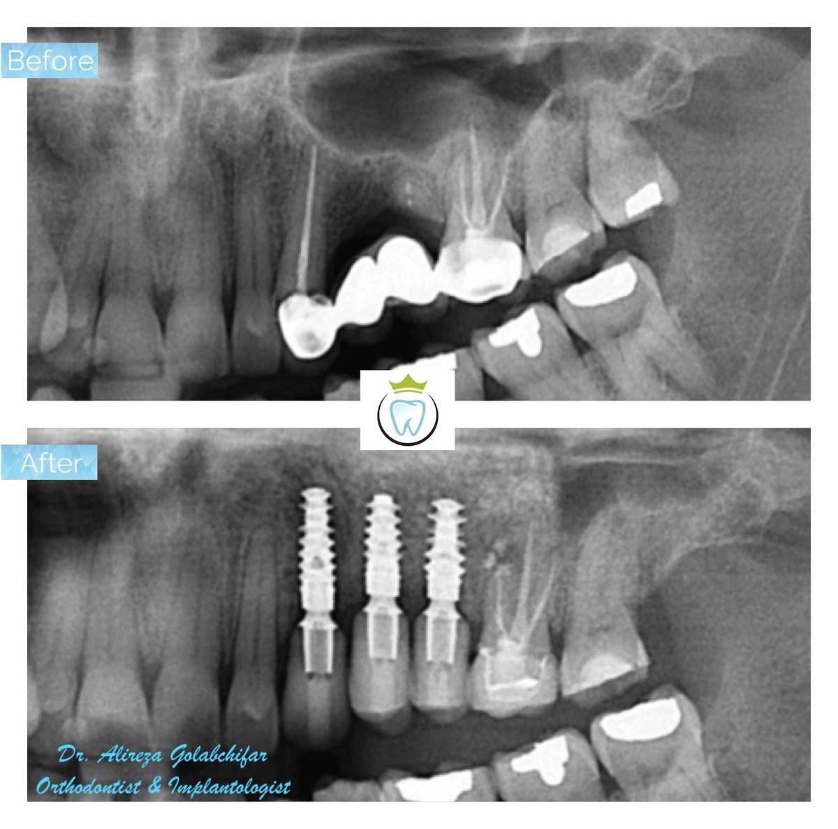 dentistry_king's tweet photo. Simultaneous immediate implant placement and lateral sinus augmentation were used to speed patient recovery and treatment time .In-office CEREC CAD/CAM was used for making the final crowns.

#implant #sinuslift #indirectsinuslift #cosmeticdentistry #Straumann #kingwestdentistry https://t.co/KSdFBPkQh4
