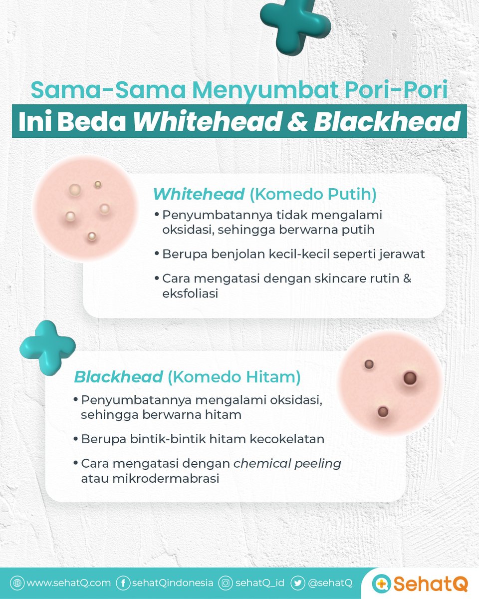 sehatq's tweet photo. Komedo putih dan hitam, bedanya apa sih? 👃🏼

Coba simak langsung perbedaan keduanya, yuk!

#skincaretips #tipskecantikan #perawatanwajah #perawatankulit #menghilangkankomedo #whitehead #blackhead #komedo #SehatQ https://t.co/SybRY8Em7P