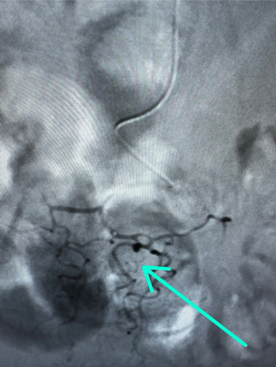 AustinBourgeois's tweet photo. Amazing how a quality pre-planning CTA and the latest gen of small micro catheters have improved care in treatment of GI bleeds. #iRad #getselective https://t.co/jrAVRGXtB4