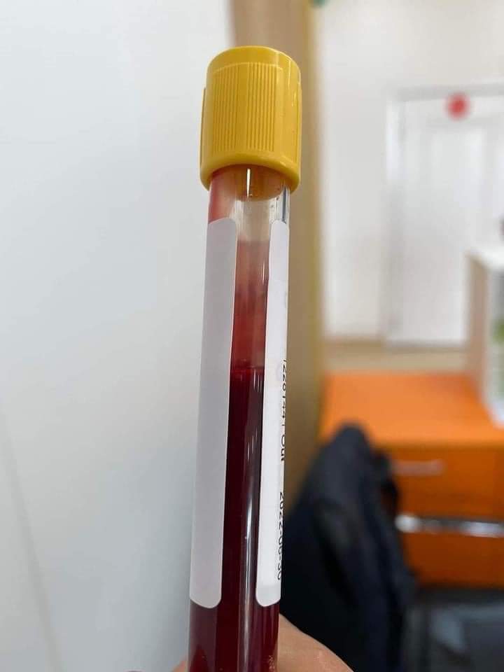 ‼️32 настай залуугийн цусны шинжилгээ! Аваад удаагүй байгаа гэтэл доошоо харуулсан байхад урсахгүй байна.
‼️ Цус маш өтгөн байна шингэн зүйл уухдаа газтай ундаа их уудаг гэнэ ус барагтаа л уудаггүй.
‼️Энэ чинь гэнэт зүрх зогсолтын гол хөшүүргэ болчихоод байна шүү дээ🙏