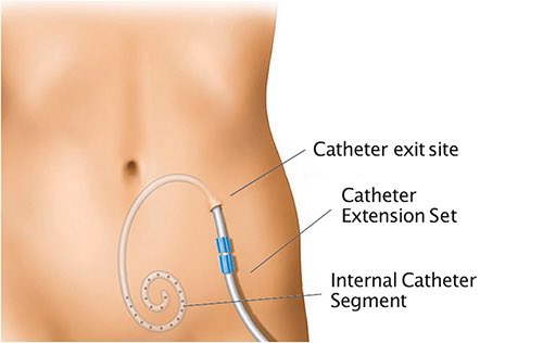 4 Types of Dialysis Access / 

1- Central venous catheter (#CVC)
2-Arteriovenous fistula (#AV_Fistula)
3-Arteriovenous graft (#AV_Graft)
4- Peritoneal dialysis catheter (#PDCatheter) .