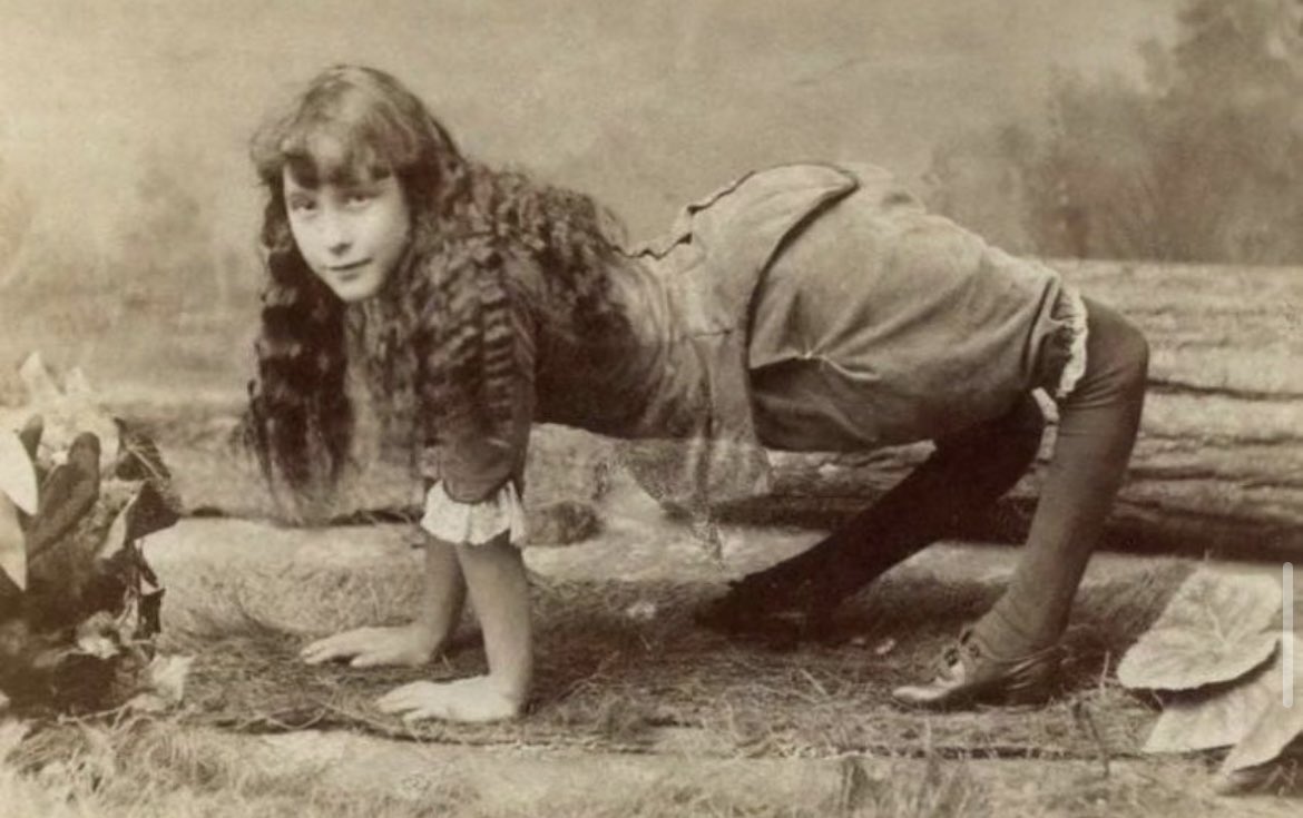 Pictured below is Ella Harper. This photograph was taken around 1885 to 1886. Harper suffered from a highly uncommon medical condition called congenital genu recurvatum, which caused her knees to bend in the opposite direction. As a result, she found it more comfortable to move