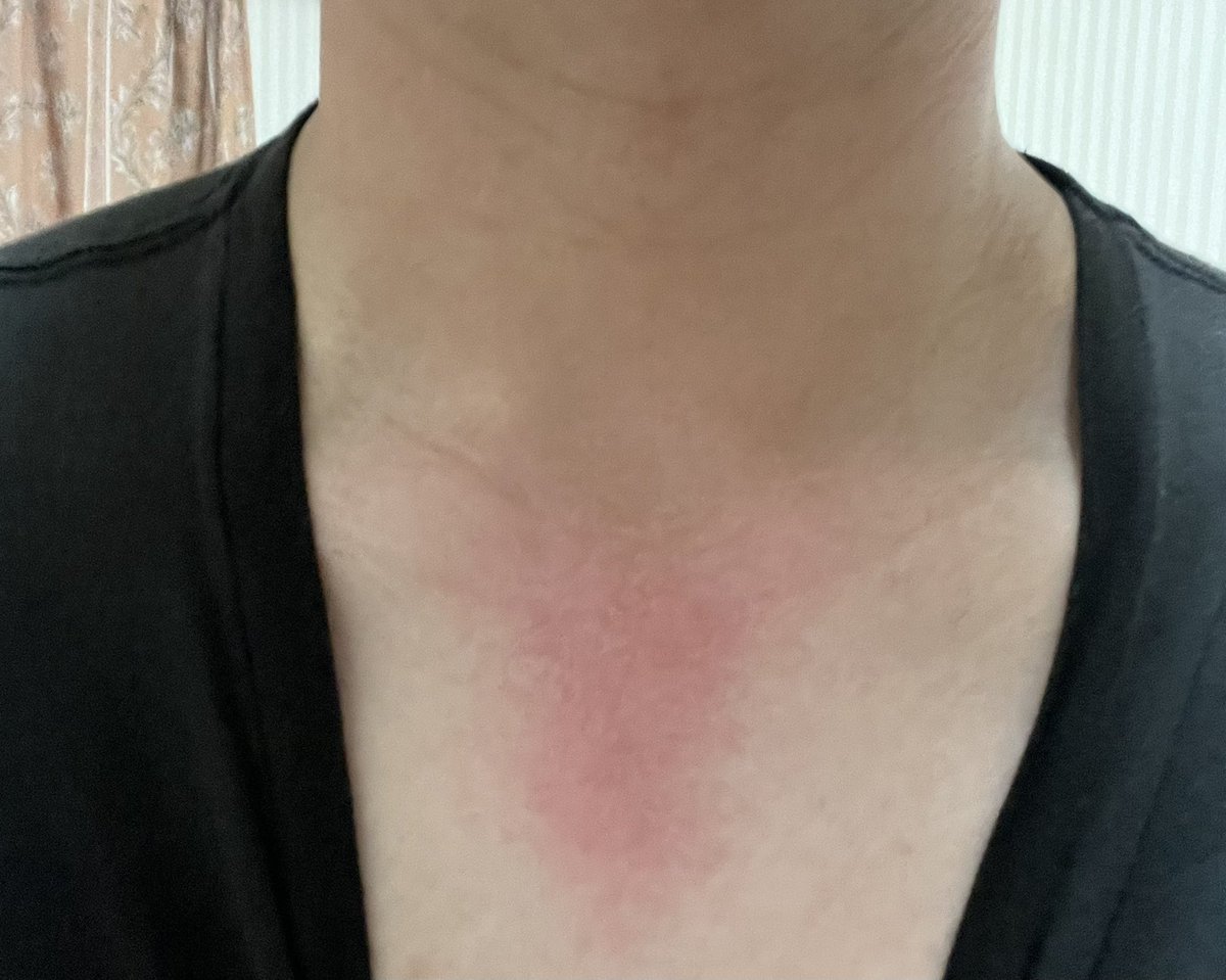 ﾄﾎﾎ､､､明日ライブなのになんで日焼け止め塗らなかったの､､､