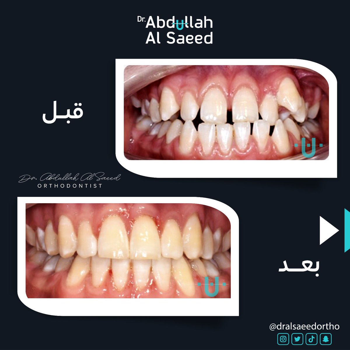 Dralsaeedortho's tweet photo. عضه معكوسه وتقدم بالفك السفلي مع ازدحام بالأسنان تم العلاج بتقويم الأسنان وبدون جراحة ومبروك لمراجعنا الابتسامه الجديده
#تقويم_الأسنان #اسنان #تقويم_اسنان #انفزلاين #تقويم
#orthocase #orthodontics_tips #orthodontix #dentistry #ortholove #invisalign https://t.co/1Cpjj06hqp
