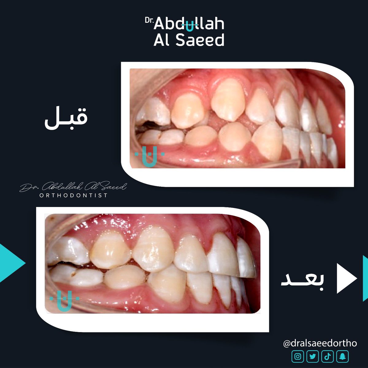 Dralsaeedortho's tweet photo. عضه معكوسه وتقدم بالفك السفلي مع ازدحام بالأسنان تم العلاج بتقويم الأسنان وبدون جراحة ومبروك لمراجعنا الابتسامه الجديده
#تقويم_الأسنان #اسنان #تقويم_اسنان #انفزلاين #تقويم
#orthocase #orthodontics_tips #orthodontix #dentistry #ortholove #invisalign https://t.co/1Cpjj06hqp