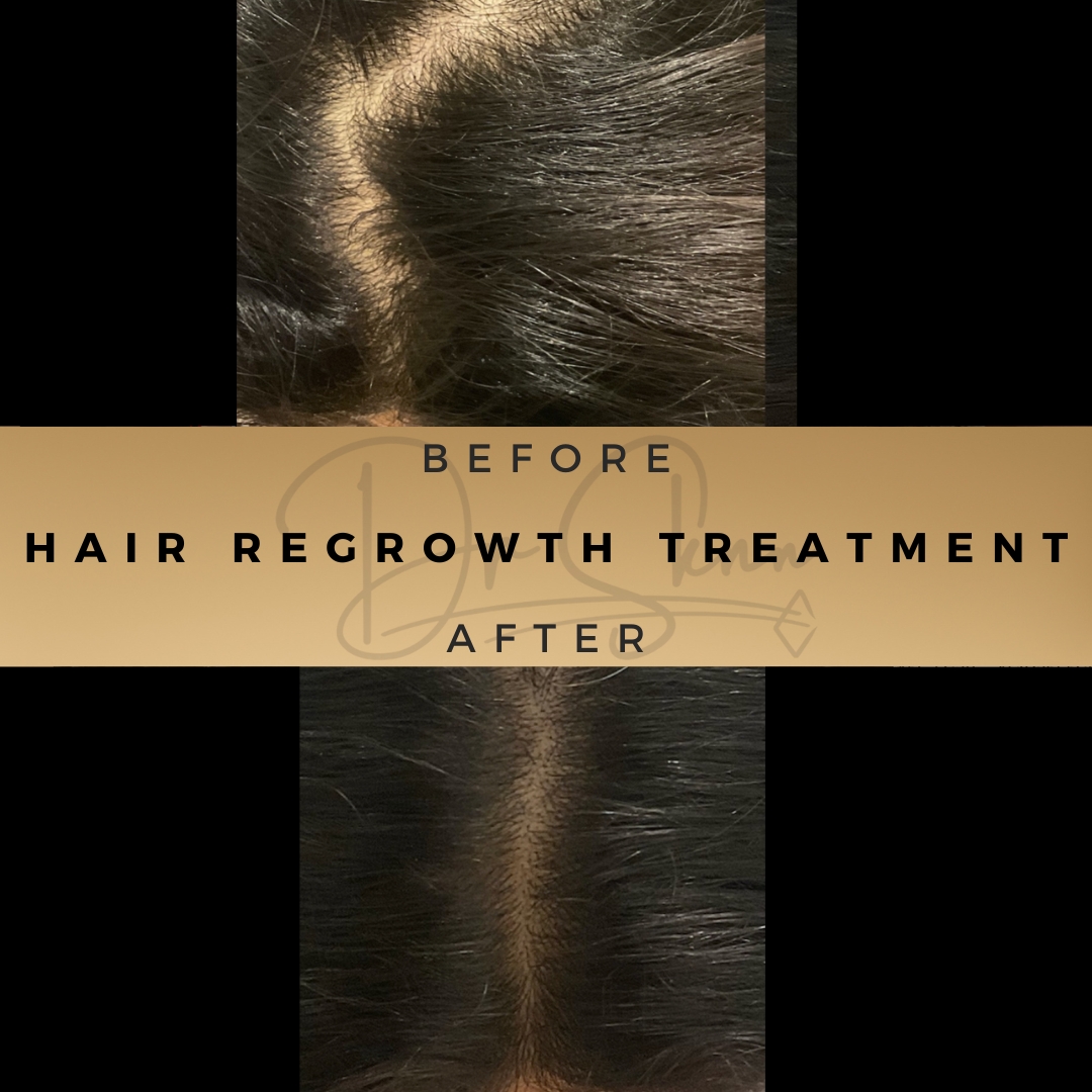 'Revive Your Hair, Revitalize Your Confidence | Dr Sknn Wilmslow Aesthetics Clinic'

#postpartumhairloss #femalehairloss #hairgrowth #hairlossspecialist #hairspecialist #congleton #cheshirebusiness #sandbach #hairthinning #scalptreatment