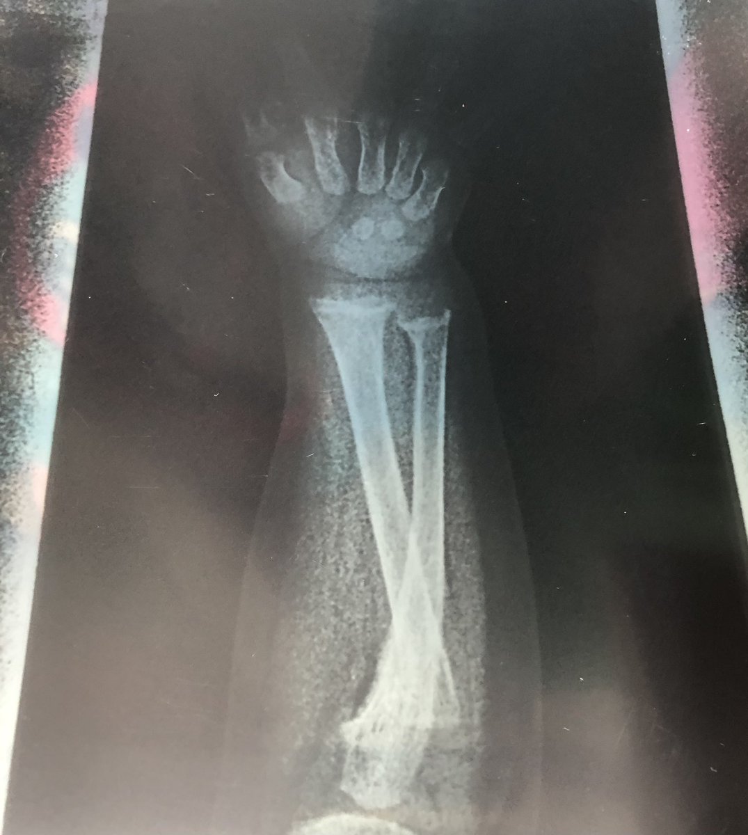 rickets again 🤦🏼‍♀️